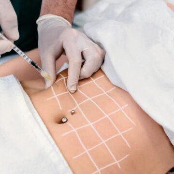 Reticula de aplicación de mesoterapia en abdomen