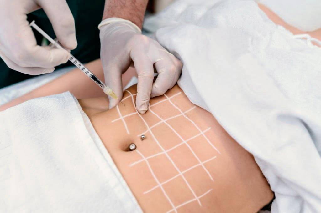 Reticula de aplicación de mesoterapia en abdomen