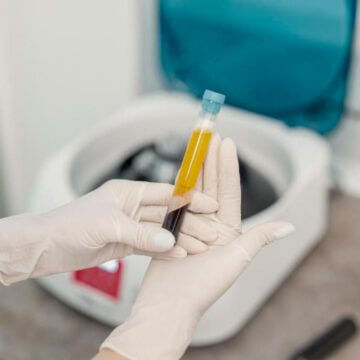 Equipo médico IOBELLA concentrando plasma rico en plaquetas PRP