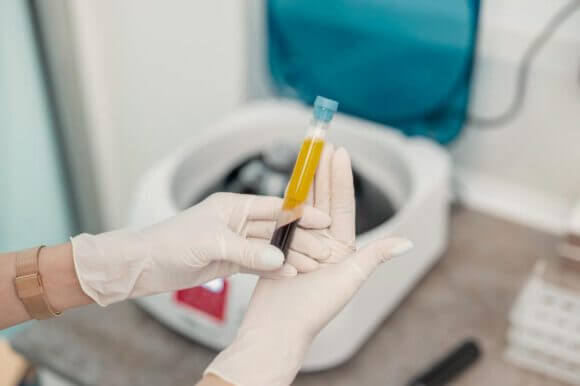 prp-plasma-rico-en-plaquetas Equipo médico IOBELLA concentrando plasma rico en plaquetas PRP